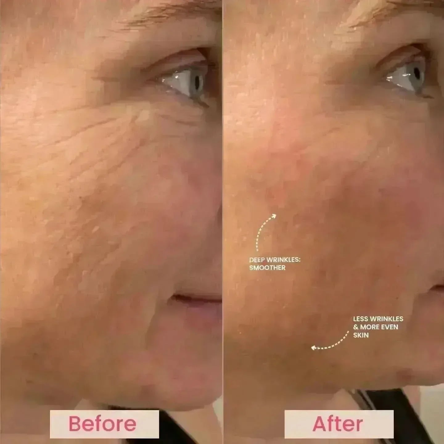 EvenSkyn® Lumo⁺: Premium Anti-Aging & Skin Tightening Handset (2026)