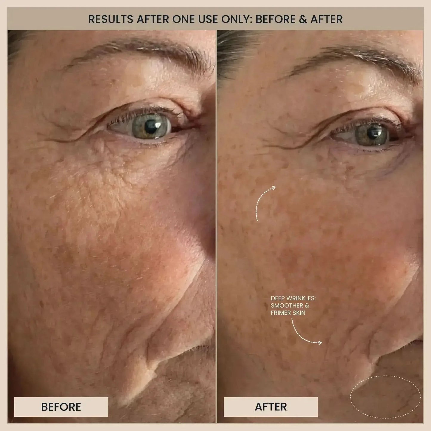 Lumo⁺ + Phoenix: Professional-Grade Skin Tightening and Lifting Duo