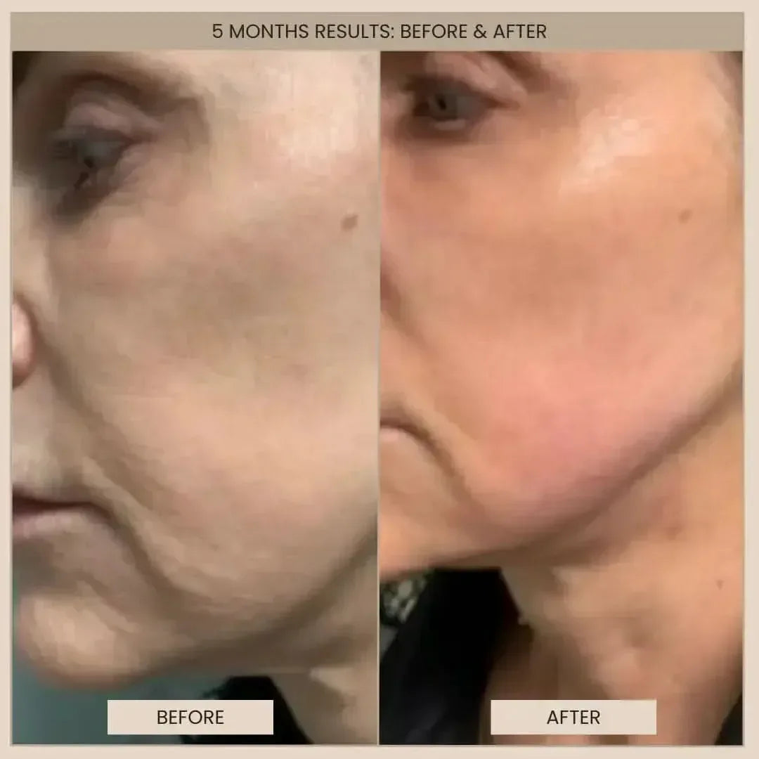 Lumo⁺ + Phoenix: Professional-Grade Skin Tightening and Lifting Duo