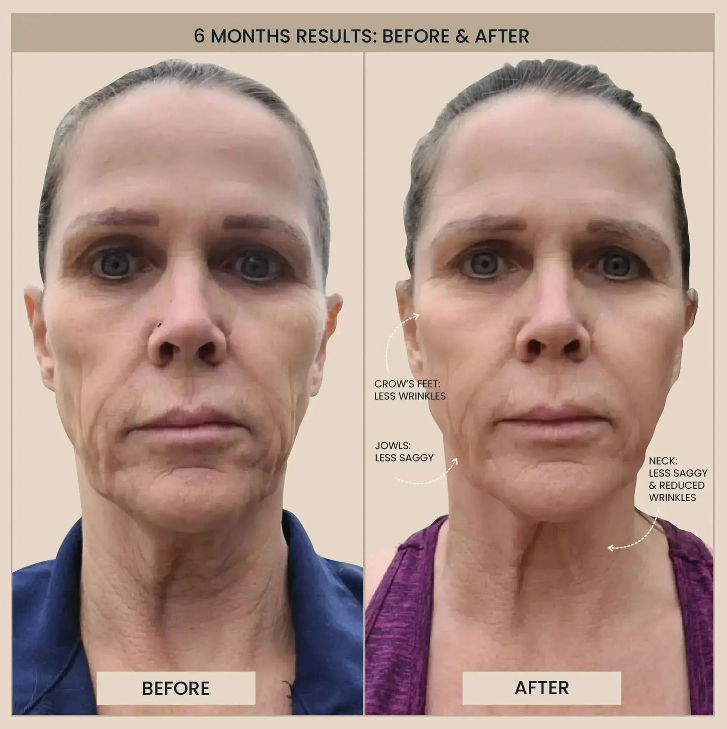 EvenSkyn® Lumo⁺: Premium Anti-Aging & Skin Tightening Handset (2026)